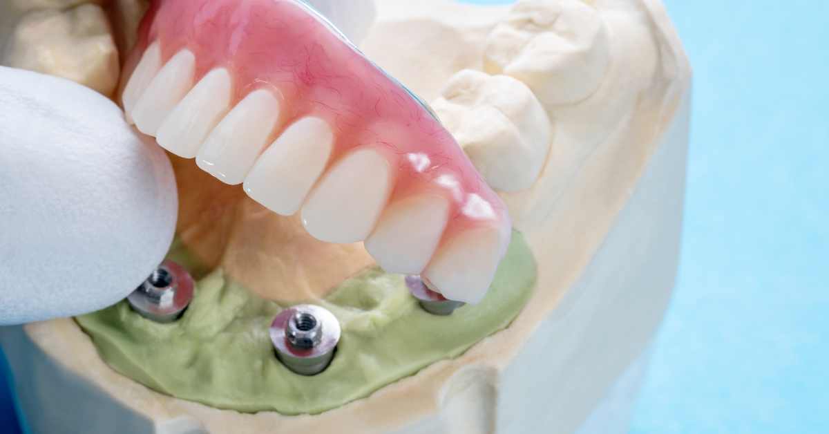Local Implants Guide Blogging: Choosing the Right Implants - Local ...